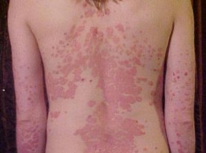 Erythrodermic psoriasis