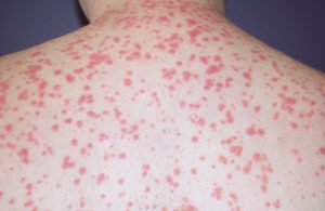 Guttate Psoriasis