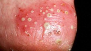 Pustular Psoriasis