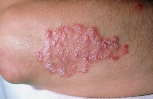 plaque psoriasis