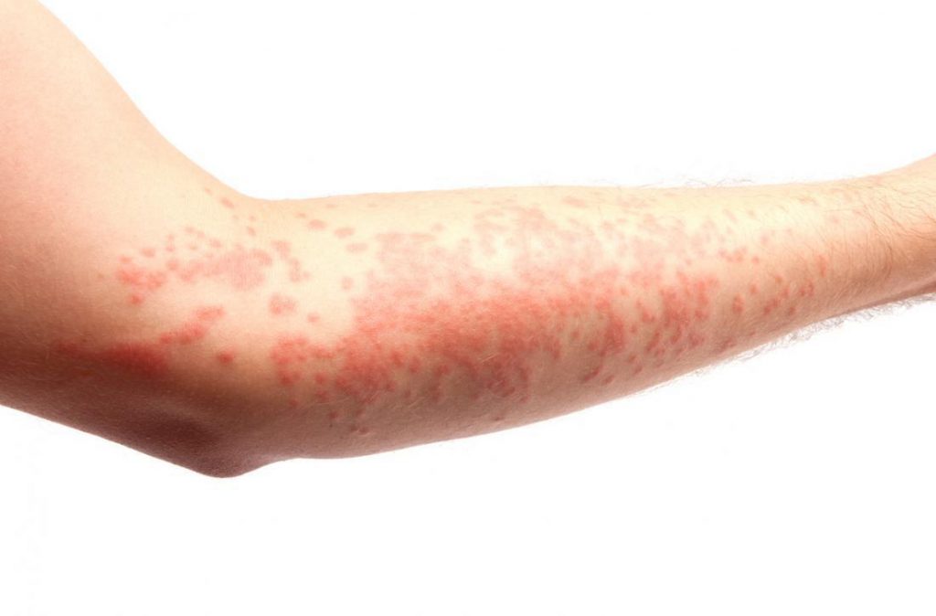 Hives Symptoms: What They Look Like