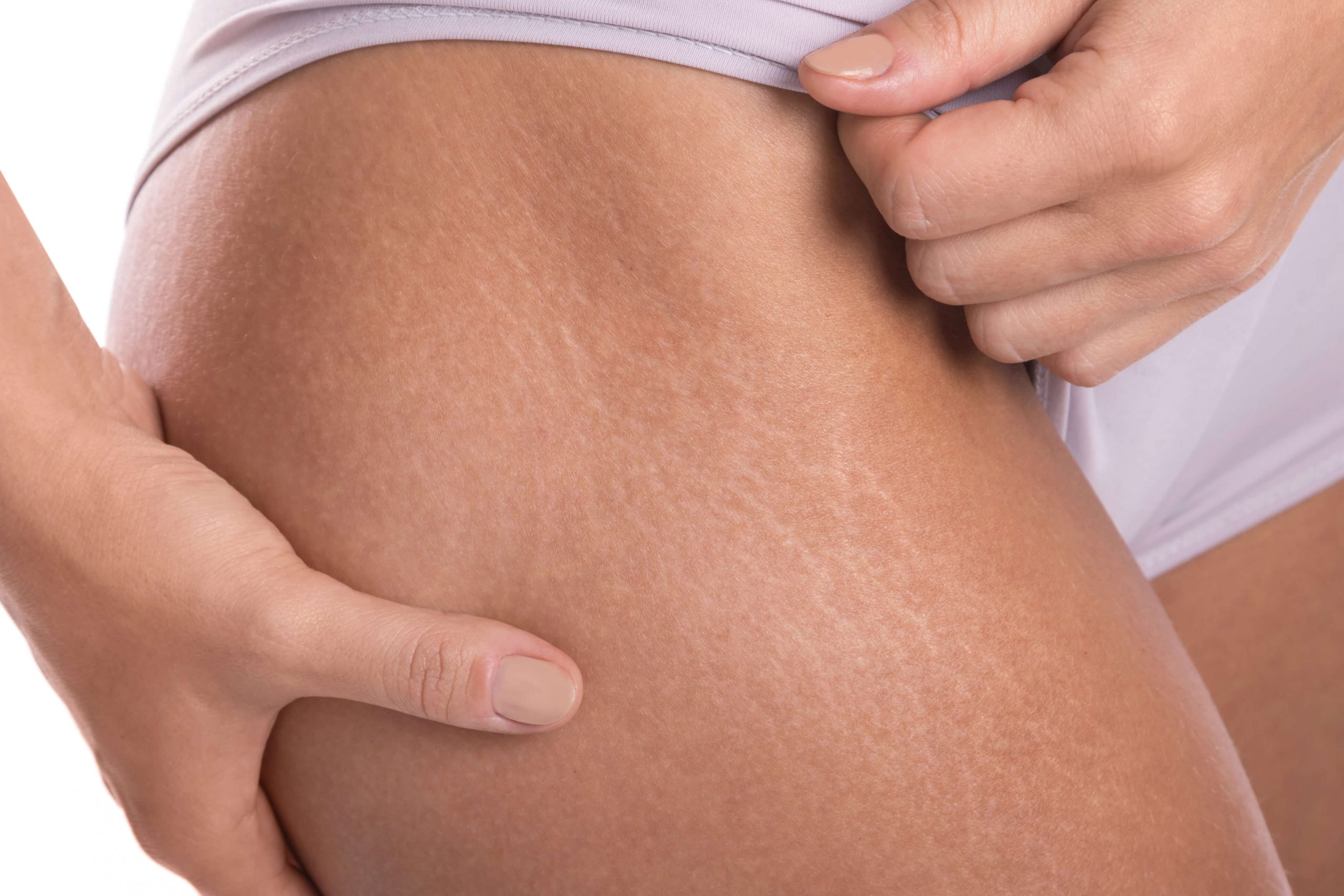 Preventing stretch marks